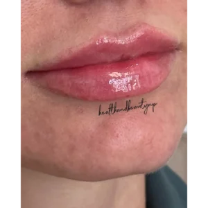 Lip Filler