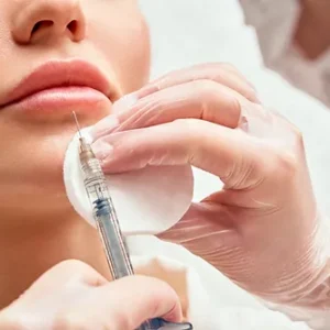 Restylane Filler - buy 2 syringes