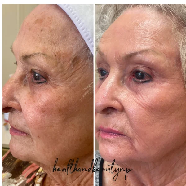 result-before-after-aa-by-ARME-PLLC-in-Kingsport-TN