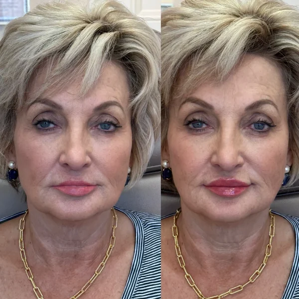 result-before-after-d-by-ARME-PLLC-in-Kingsport-TN