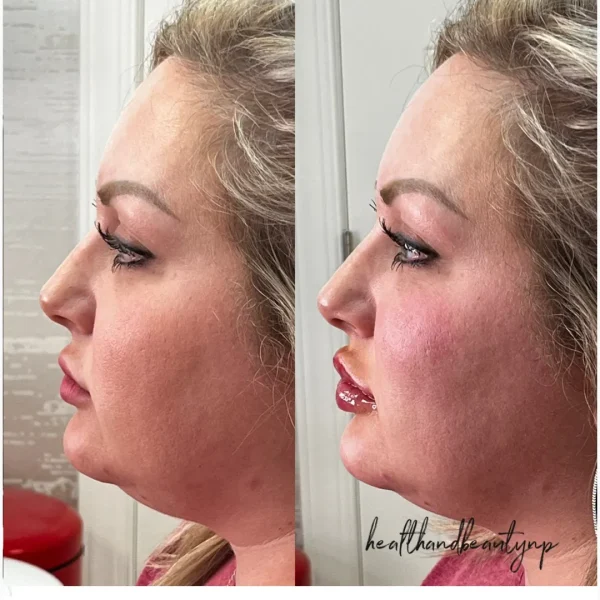 result-before-after-ff-by-ARME-PLLC-in-Kingsport-TN