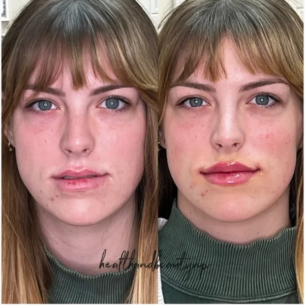 result-before-after-hh-by-ARME-PLLC-in-Kingsport-TN