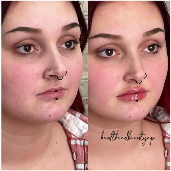result-before-after-ii-by-ARME-PLLC-in-Kingsport-TN