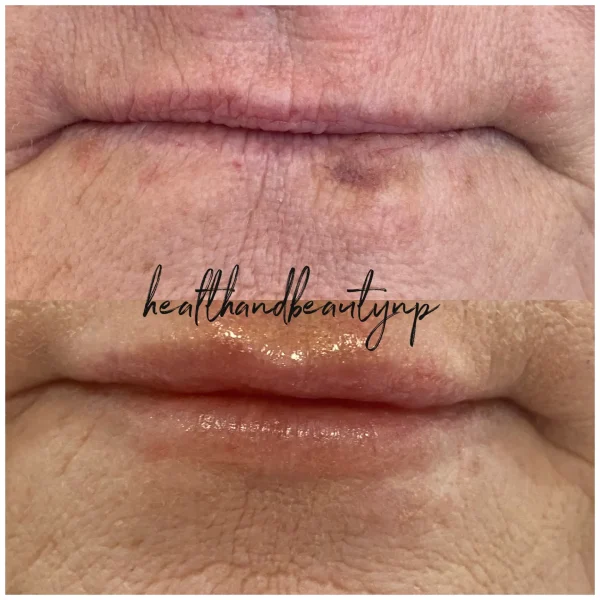 result-before-after-o-by-ARME-PLLC-in-Kingsport-TN