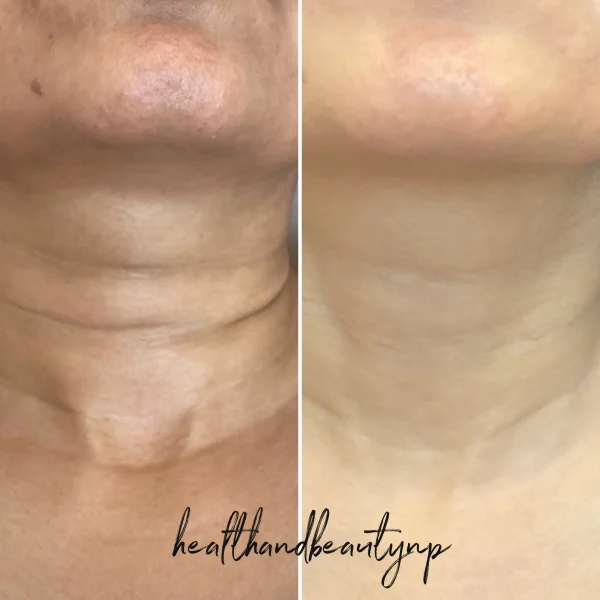 result-before-after-s-by-ARME-PLLC-in-Kingsport-TN