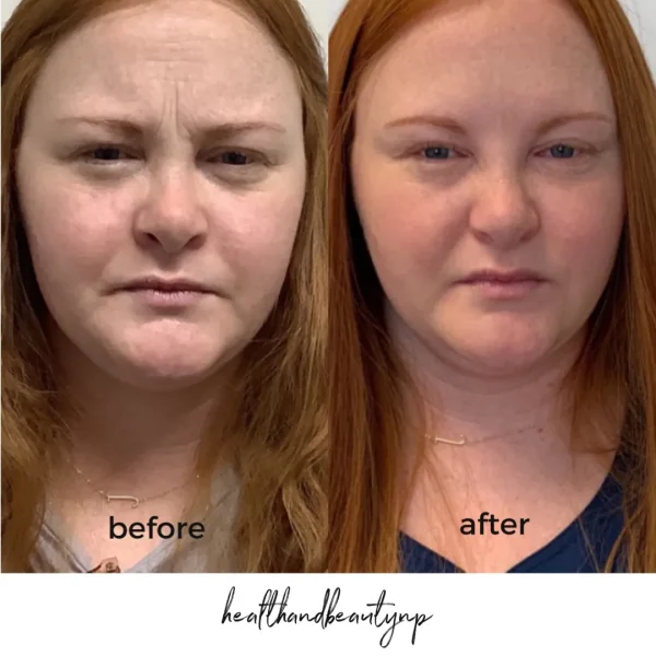 result-before-after-x-by-ARME-PLLC-in-Kingsport-TN