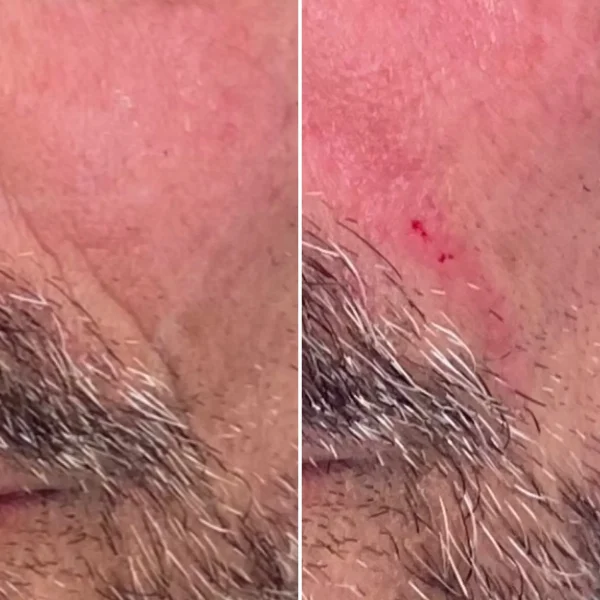 result-before-after-b-by-ARME-PLLC-in-Kingsport-TN