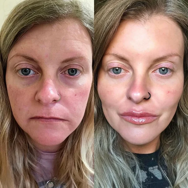 result-before-after-facial-balancing-d-by-ARME-PLLC-in-Kingsport-TN