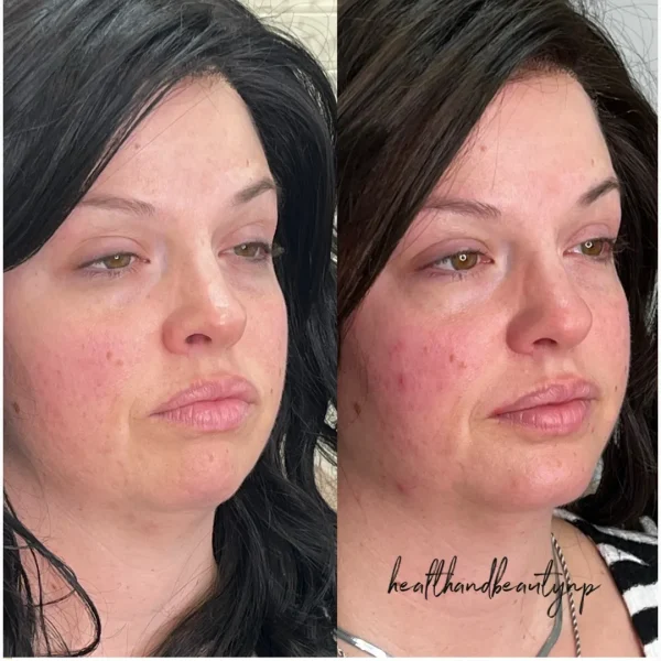 result-before-after-gg-by-ARME-PLLC-in-Kingsport-TN