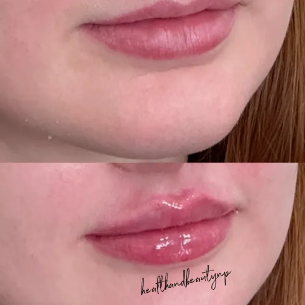result-before-after-lip-filler-a-by-ARME-PLLC-in-Kingsport-TN