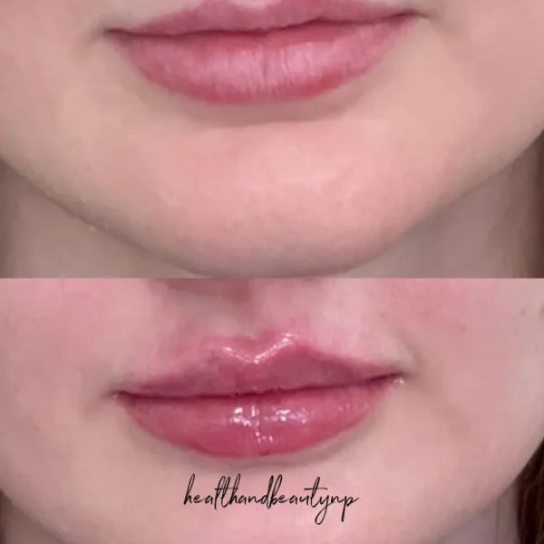 result-before-after-lip-filler-b-by-ARME-PLLC-in-Kingsport-TN