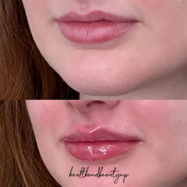 result-before-after-lip-filler-c-by-ARME-PLLC-in-Kingsport-TN