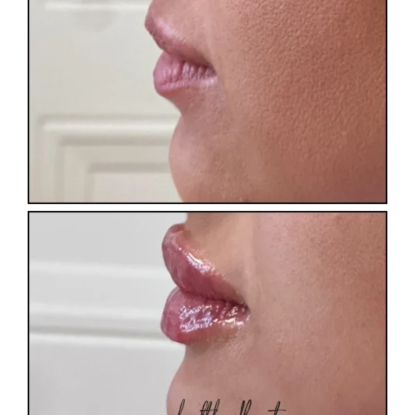 result-before-after-lip-filler-d-by-ARME-PLLC-in-Kingsport-TN