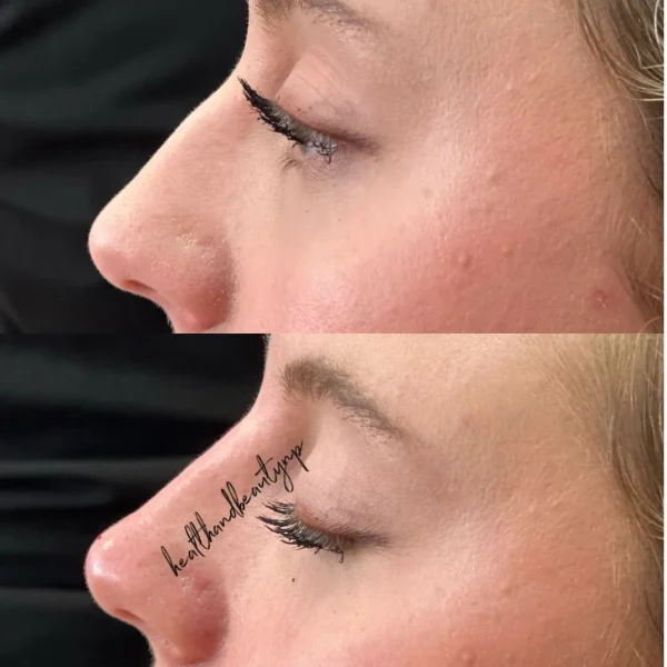 result-before-after-nose-filler-a-by-ARME-PLLC-in-Kingsport-TN