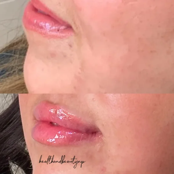 result-before-after-pp-by-ARME-PLLC-in-Kingsport-TN