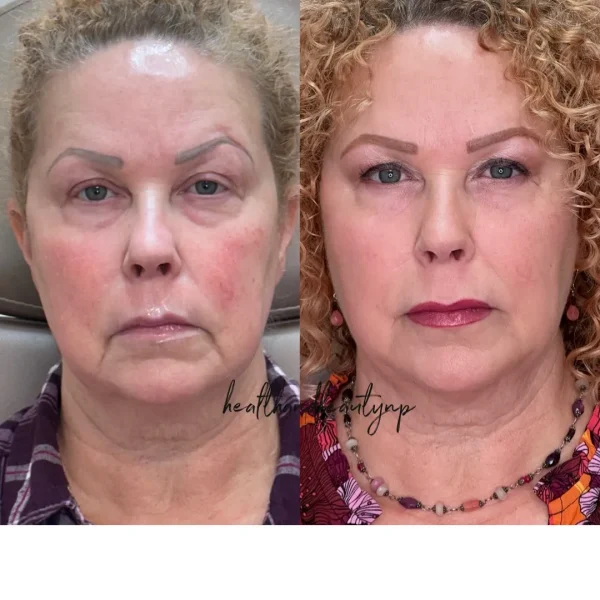 result-before-after-v-by-ARME-PLLC-in-Kingsport-TN